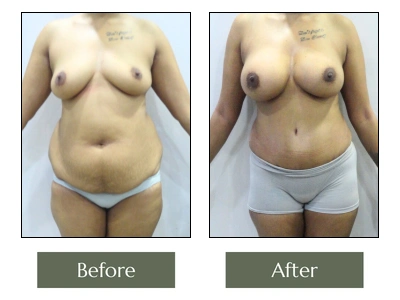 Tummy Tuck