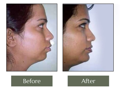 KM Chin Augmentation Right Side View KM Chin Augmentation Right Side View