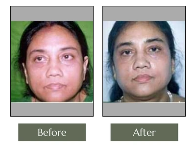Eye & Lip Surgery