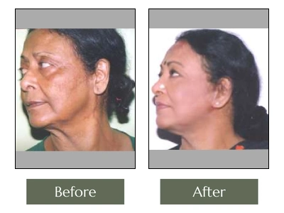 Face-Lift