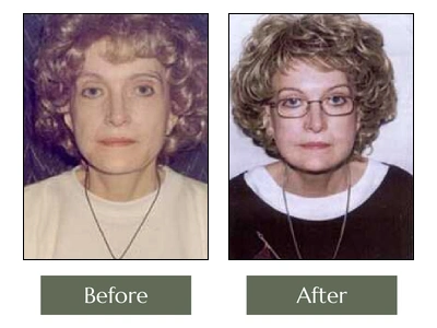 Face-Lift