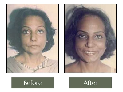Face-Lift