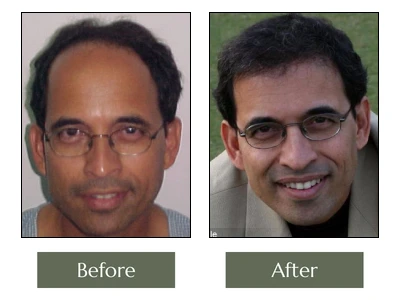 Hair Transplant