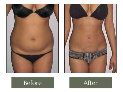 Liposuction