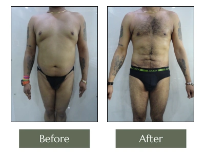 Liposuction