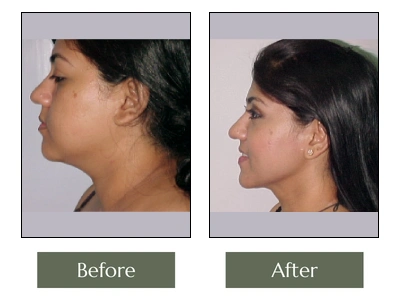 PB Chin Liposuction Left Side View PB Chin Liposuction Left Side View