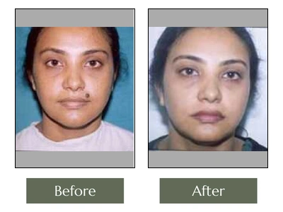 Scar & Mole Removal Scar & Mole Removal